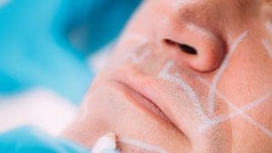 Read more about the article What are dermal fillers? Benefits And effects