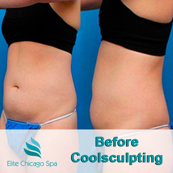 woman before coolsculpting