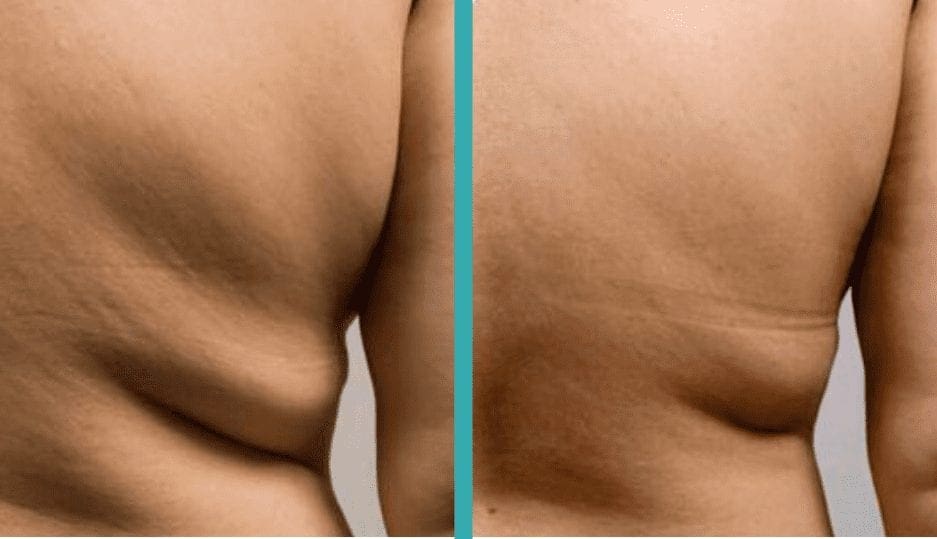Best CoolSculpting chicago for men