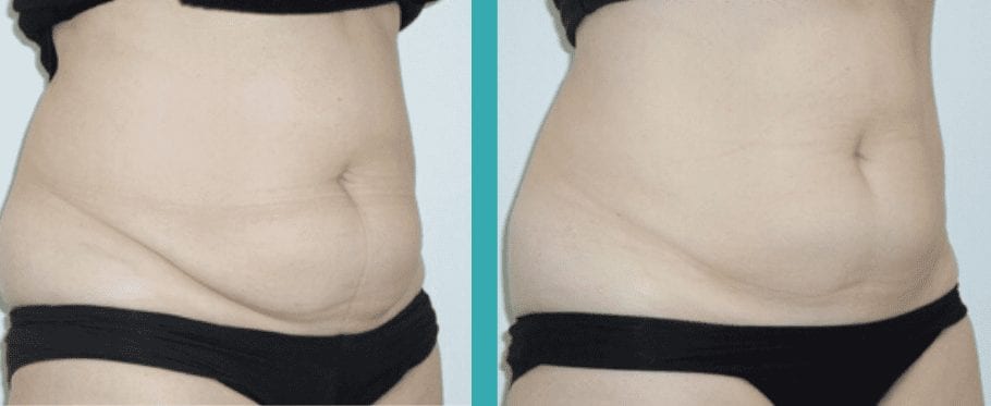 Coolsculpting Chicago Before and After