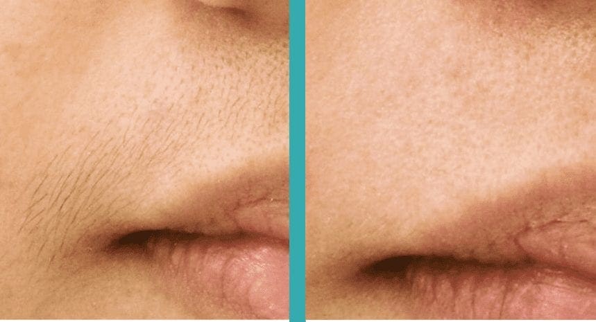 Lip laser hair removal chicago