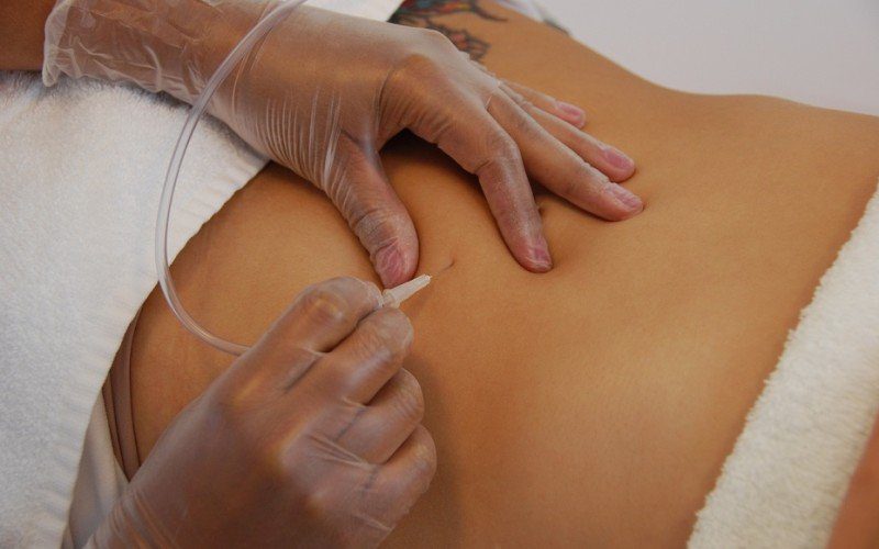 Carboxytherapy in Chicago
