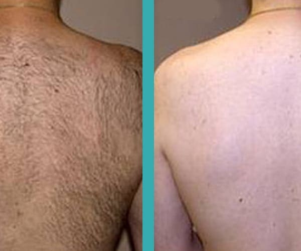 best laser hair removal chicago