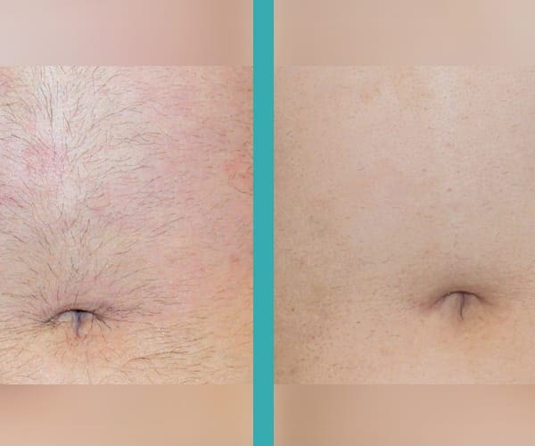best laser hair removal chicago