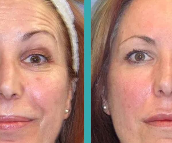 Read more about the article Where Can You Get The Best Botox Chicago Treatment?