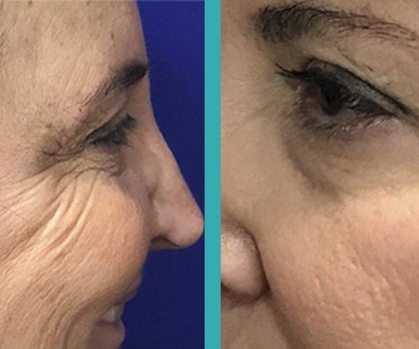 Crows feet botox before and after on woman