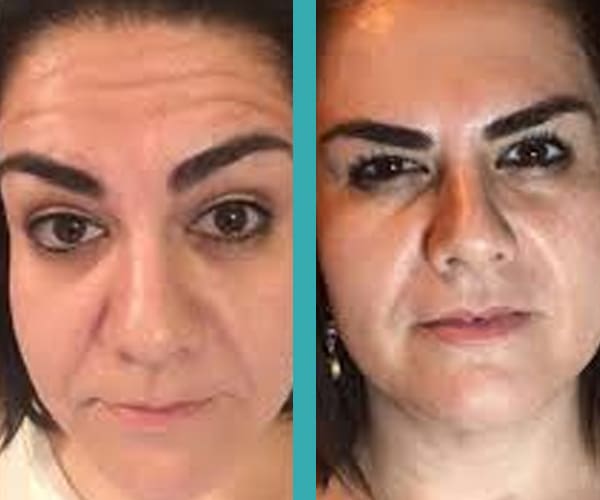 botox wrinkle reduction on female patients in Chicago