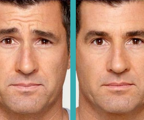 botox treatment on Forehead of a Man