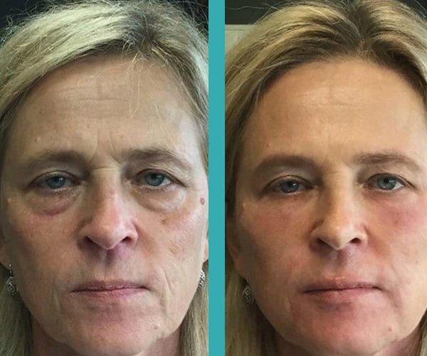 Botox Injections on Forehead and under eyes