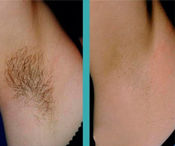top laser hair removal