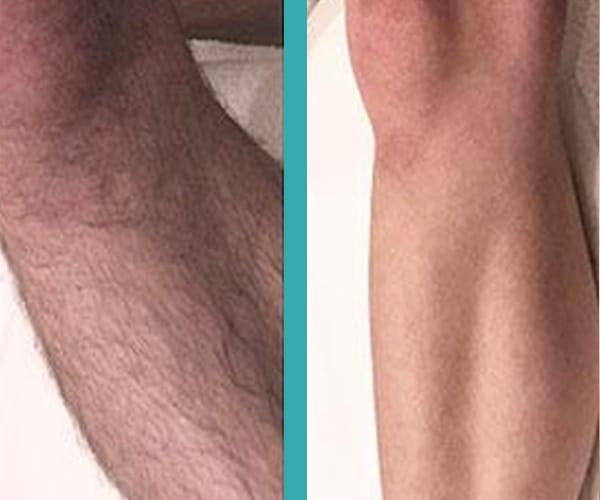 top laser hair removal