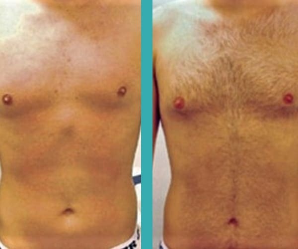 top laser hair removal