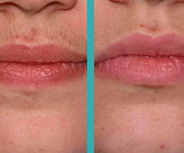 top rated laser hair removal chicago