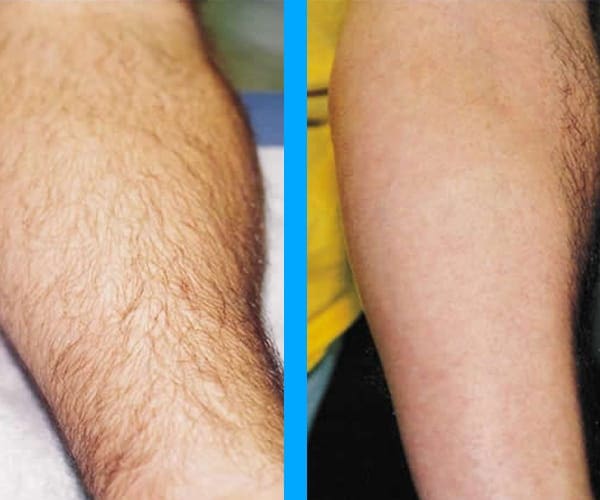 top rated laser hair removal chicago
