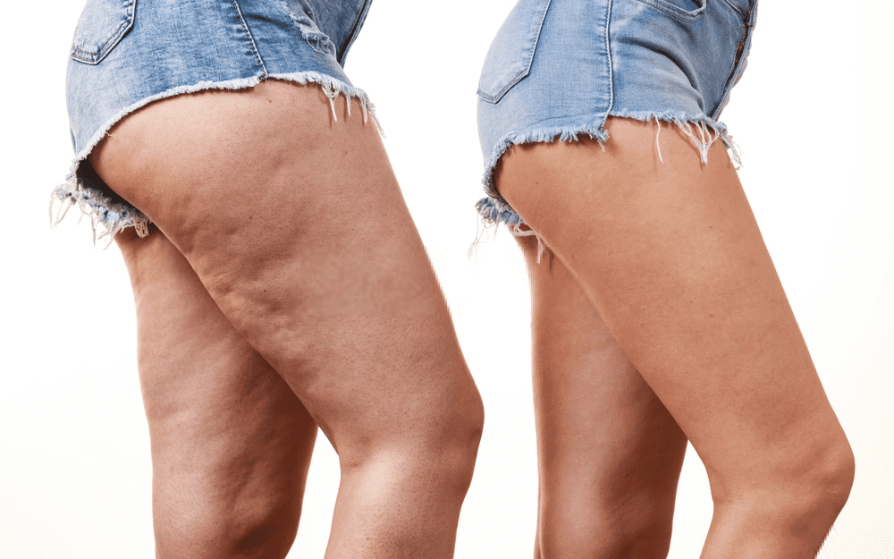 what-is-cellulite
