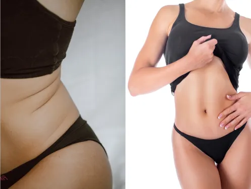 how-many-session-does-it-take-to-see-results-with-ultrasonic-cavitation