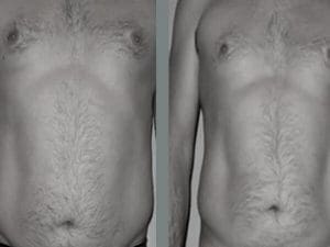 Cryolipolysis In Chicago