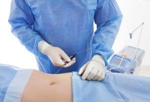 Read more about the article Common Lipolaser Questions