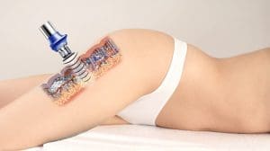 Read more about the article Science and Ultrasonic Cavitation