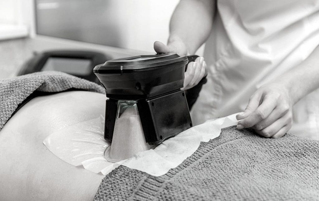 cryolypolisis fat reduction