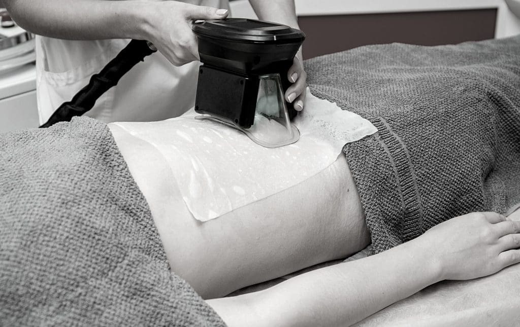 cryolypolysis