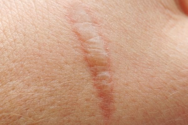 Laser lipo burns