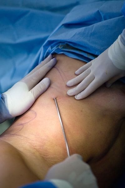 laser lipo after