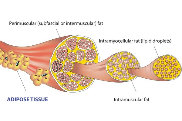 intermuscular-fat-from-types-of-body-fat