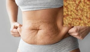 Read more about the article Types Of Body Fat And How To Eliminate It