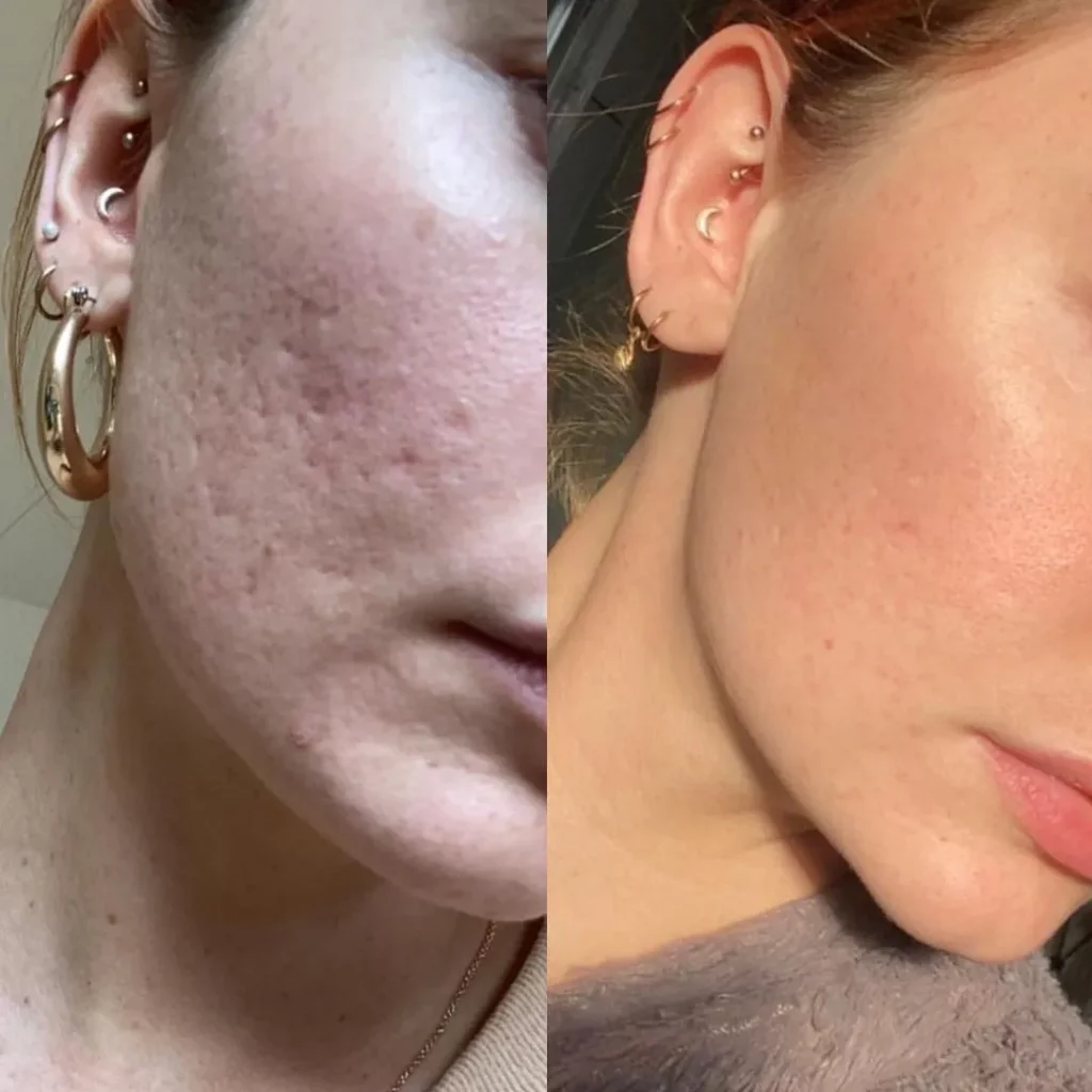 what-to-do-after-nano-needling