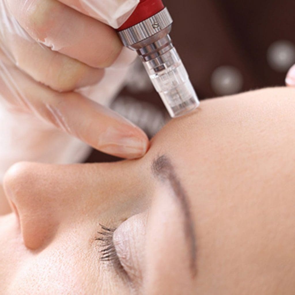 Microneedling Forest Park IL