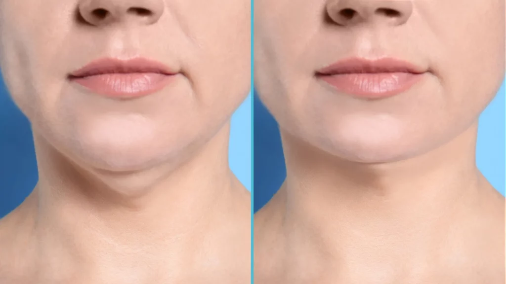 bye-bye-double-chin-permanently