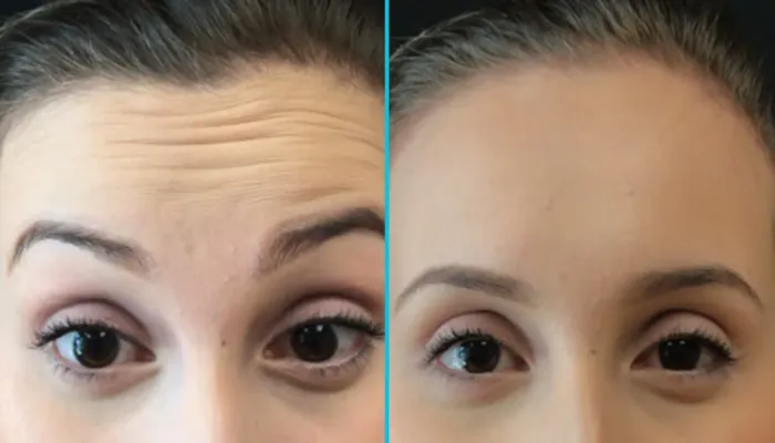 You are currently viewing Lifting Threads: Youthful Skin Revival