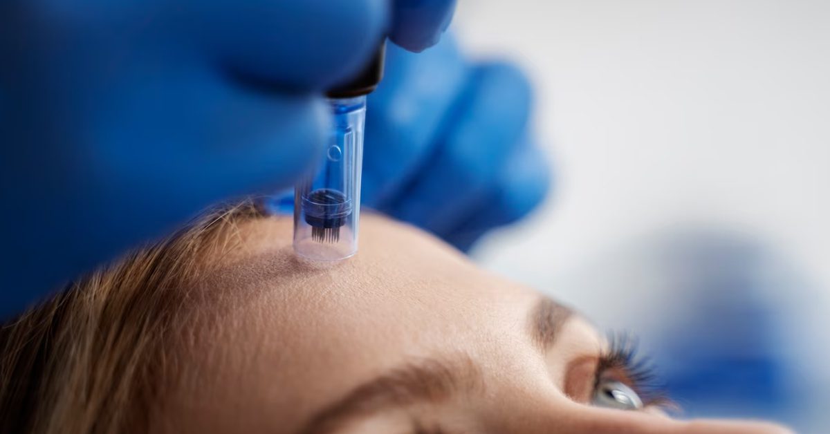 You are currently viewing Painless Beauty: Micro-needle Therapy