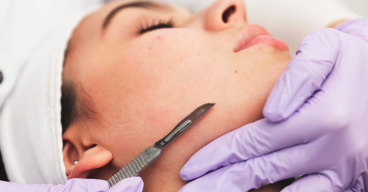 You are currently viewing Revitalizing Skin: Chicago’s Dermablading Delight
