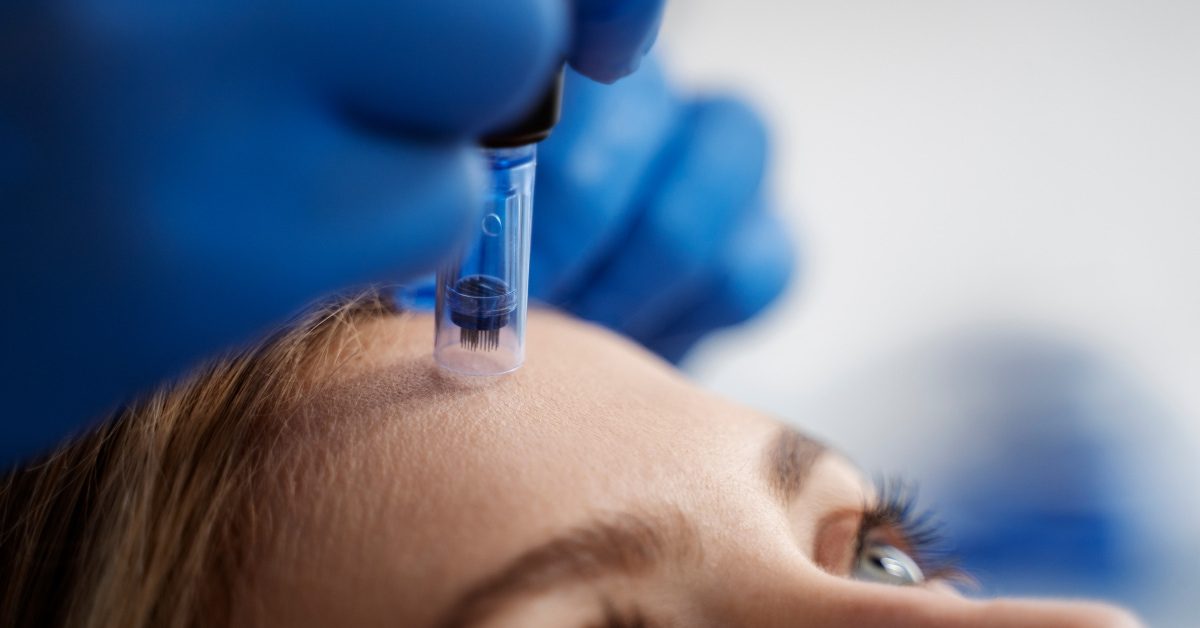 Read more about the article Revolutionizing Skincare: Micro-needle Therapy