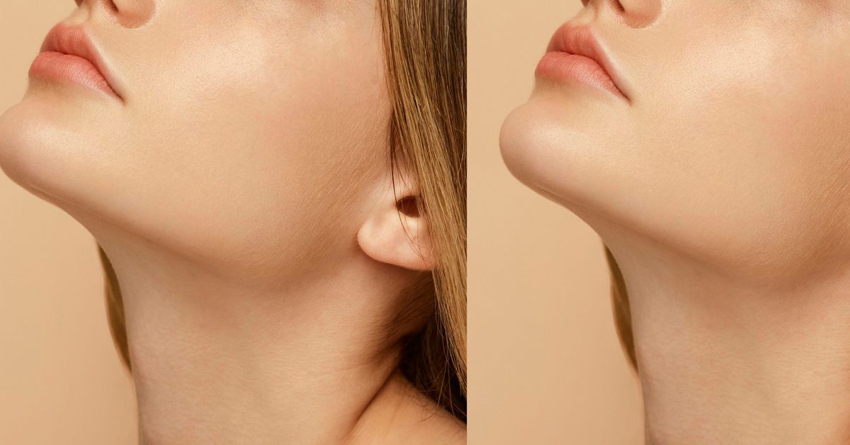 Read more about the article Trimming Neck Fat: Effective Solutions