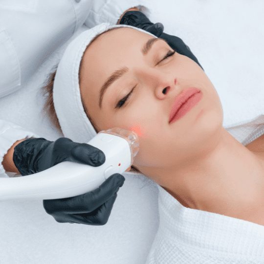 Microneedling Andersonville IL