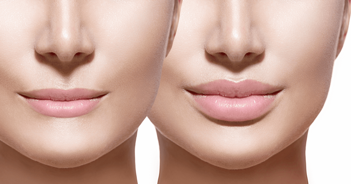 Read more about the article Lip Fillers and Facial Harmony