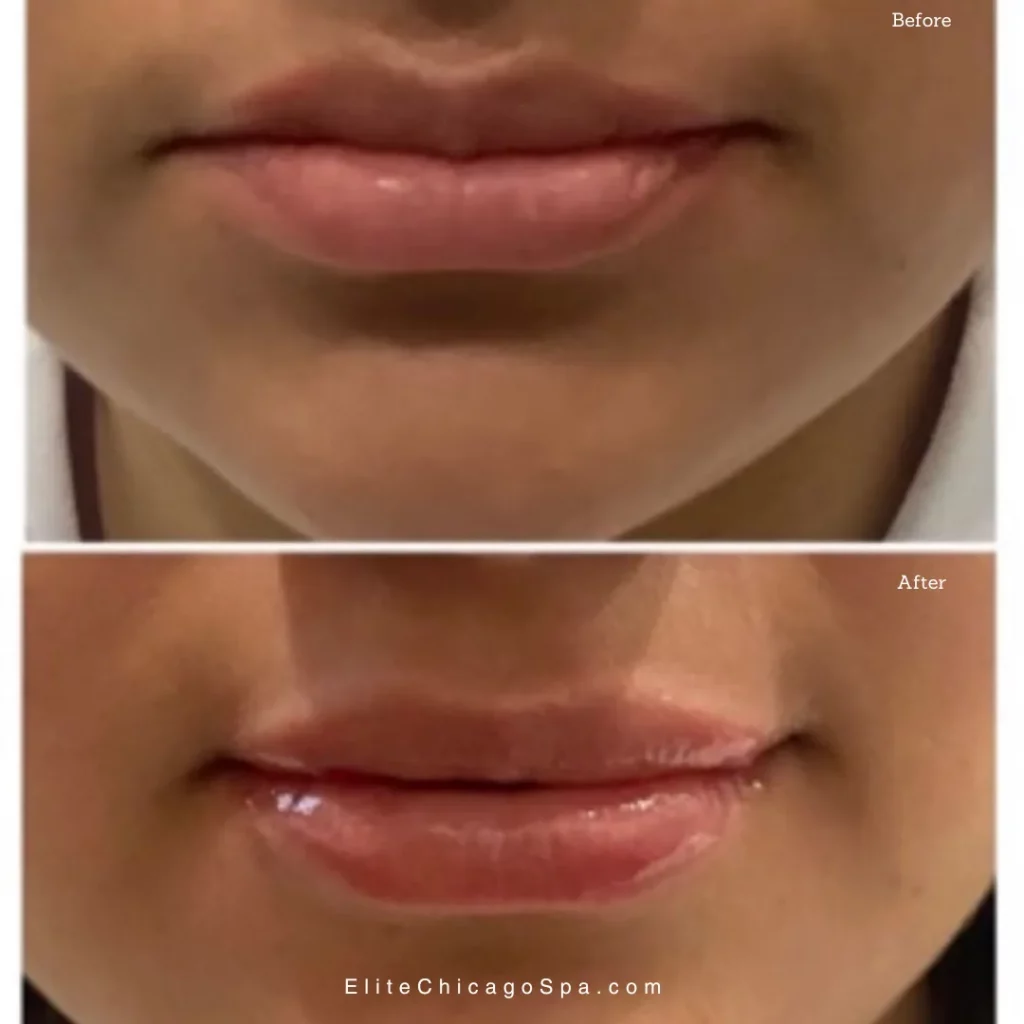 lip-fillers-vs-lip-implants