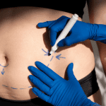 Lipo Laser for Post-Pregnancy Body