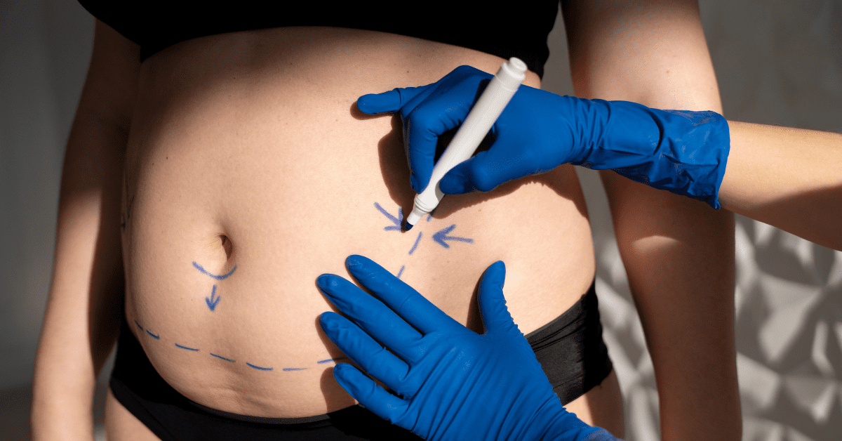 You are currently viewing Lipo Laser for Post-Pregnancy Body
