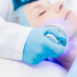 The Benefits of Fractional RF Treatment for Acne Scars