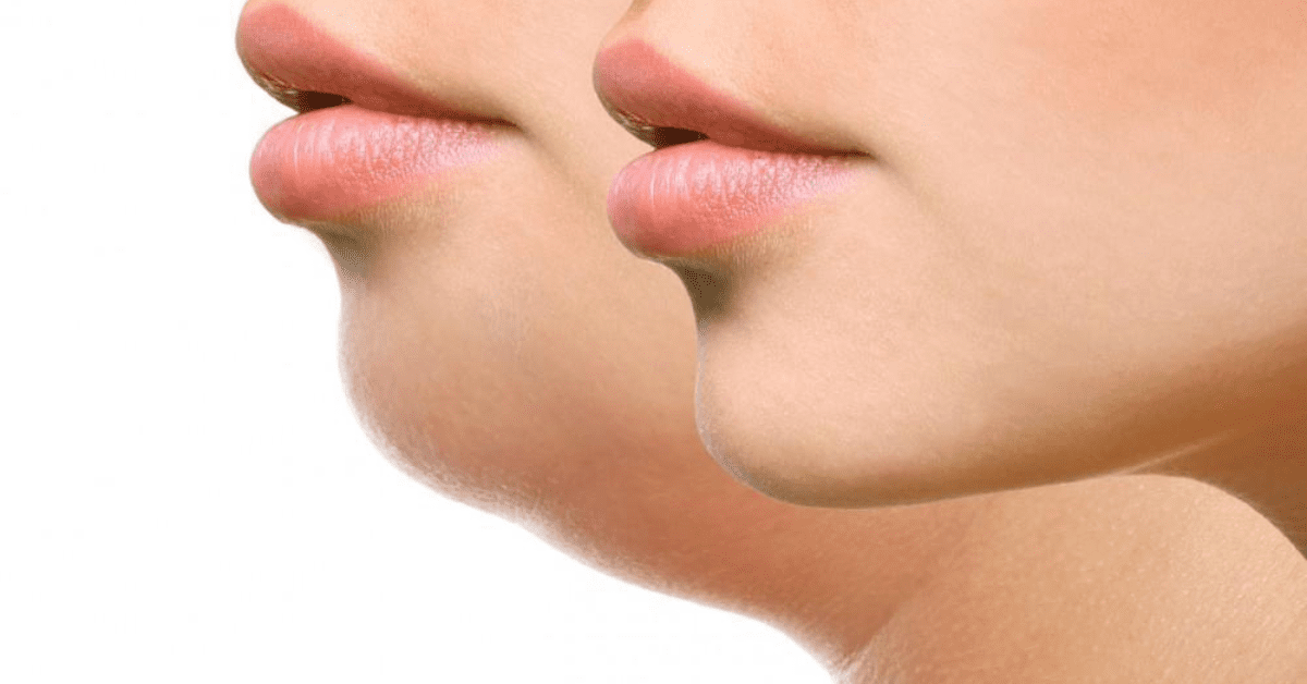 Read more about the article Understanding Double Chin: Causes