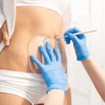 Preparing and Caring Post CoolSculpting: A Guide