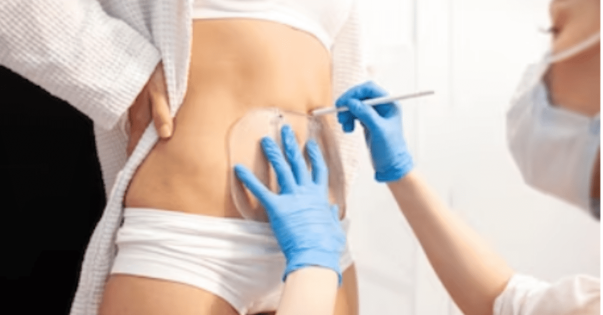 You are currently viewing Preparing and Caring Post CoolSculpting: A Guide