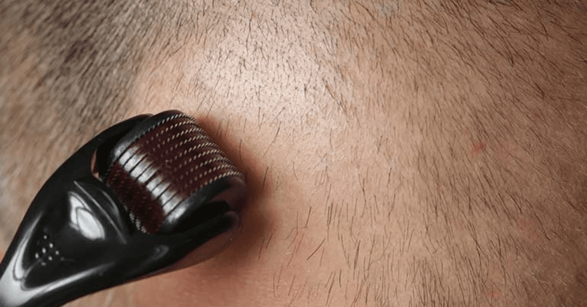 Read more about the article Revitalize Hair Growth: Microneedling for Hair Loss