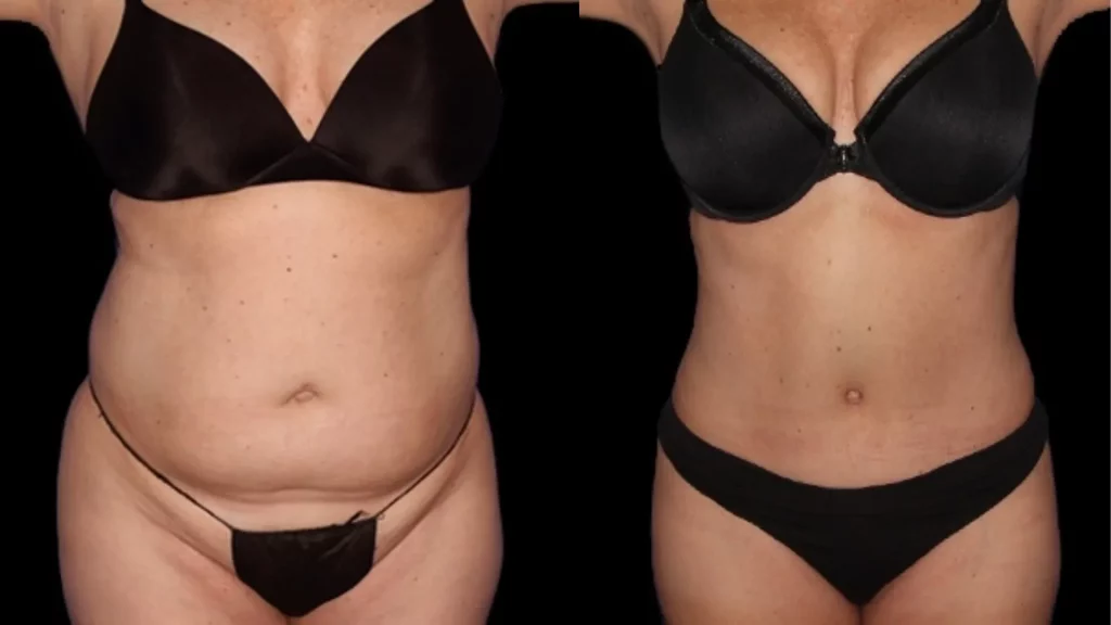 is-ultrasonic-cavitation-harmful
