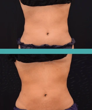 Before and After Fat Reduction Abdomen-Elite Chicago Spa