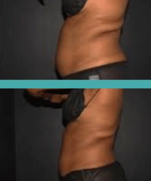 Before and After Fat Reduction of Female African American Patient